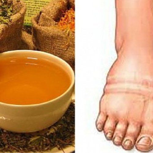 Tout ce qu’il faut savoir sur la rétention d’eau, causes, solutions, astuces