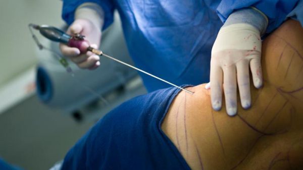 La liposuccion : l'abdomen, les hanches, les fesses, les cuisses
