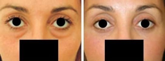 Blepharoplastie Tunisie : Prix chirurgie paupières, devis gratuit | Chirurgie esthétique en Tunisie