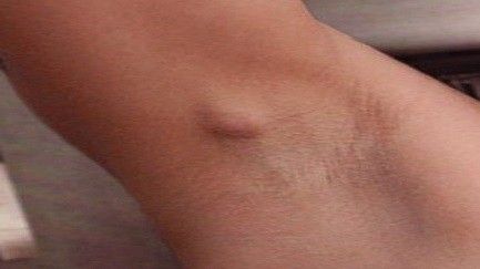 Boule sous l'aisselle (Petite, Douloureuse): Causes et Traitements