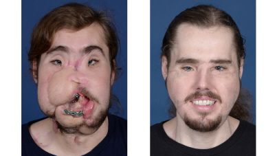 Une greffe de visage spectaculaire après une tentative de suicide