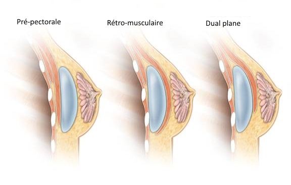 Augmentation mammaire Tunisie : Prix pose implant mammaire