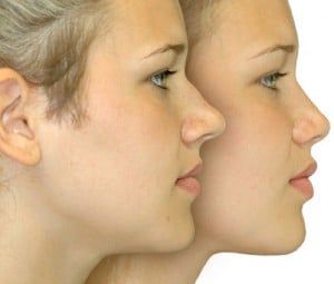 Rhinoplastie Tunisie : Chirurgie esthétique du nez