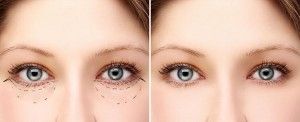 Blépharoplastie Tunisie : Chirurgie esthetique des paupieres