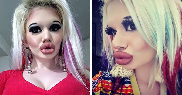 Cette femme a triplé la taille de ses lèvres pour être « plus à la mode »