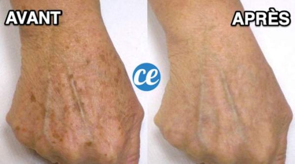 Le Truc de Grand-Mère Contre Les Taches Brunes.