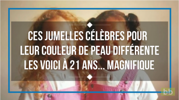 Ces jumelles sont célèbres pour leur couleur de peau différente. les voici à 21 ans…