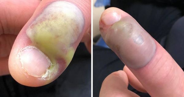 Une femme a contracté une infection mortelle après s’être rongé les ongles