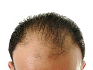 Greffe de cheveux tunisie : Implant sans cicatrices.