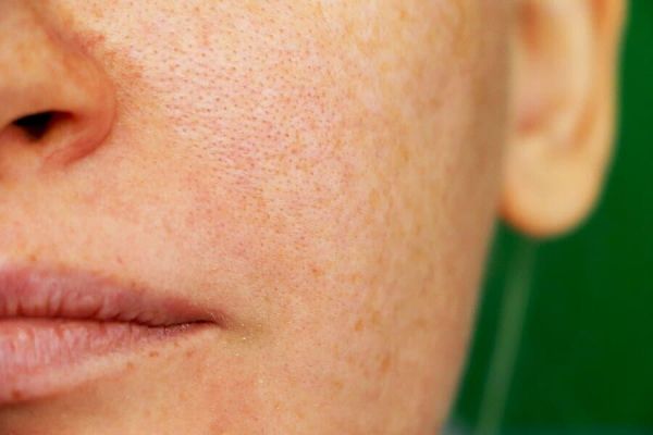 Remèdes contre le mélasma : 3 alternatives naturelles