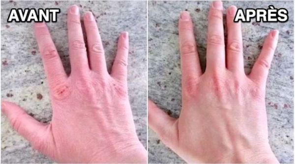 Mains Abîmée Par le Gel Hydroalcoolique ? Le Remède Miracle et Instantané.