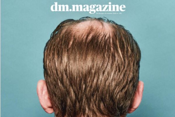 La calvitie, une histoire à s'arracher les cheveux