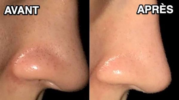 L'Astuce Magique Pour Se Débarrasser des Points Noirs Avec du Bicarbonate.