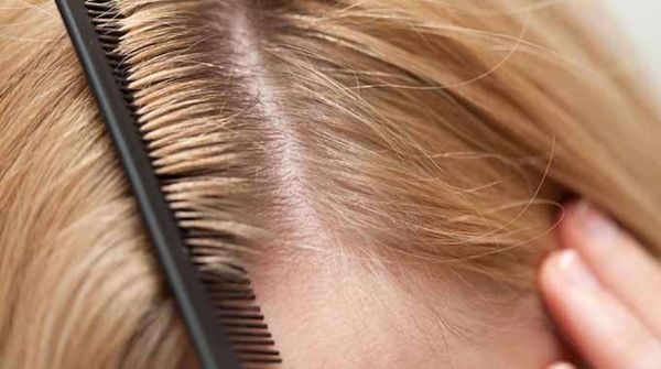 Une Astuce de Grand-mère Efficace Contre les Pellicules.
