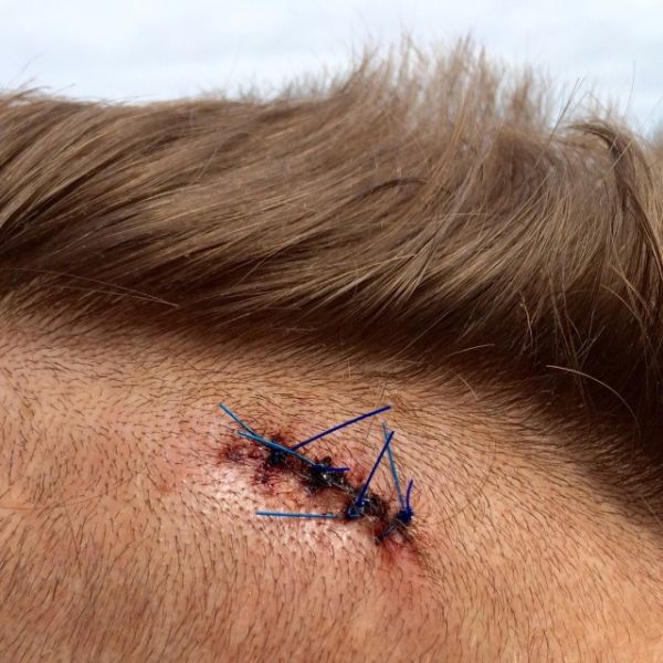 Sécu : les 1ères poses de puces RFID sous la peau, remplaçant les cartes vitales, ont commencé un peu partout en France. - lejournalnews.com