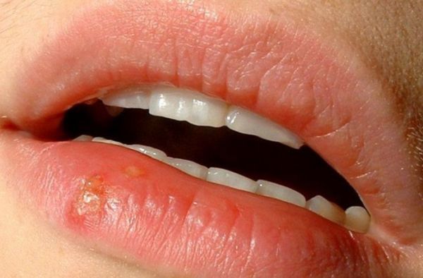 Comment venir à bout du bouton de fièvre : le docteur Martine Perez vous répond
