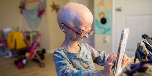 Lutte contre la progeria : les dernières techniques d'édition du génome suscitent l'espoir
