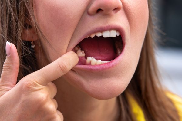 Ils découvrent un anticorps capable de régénérer les dents !