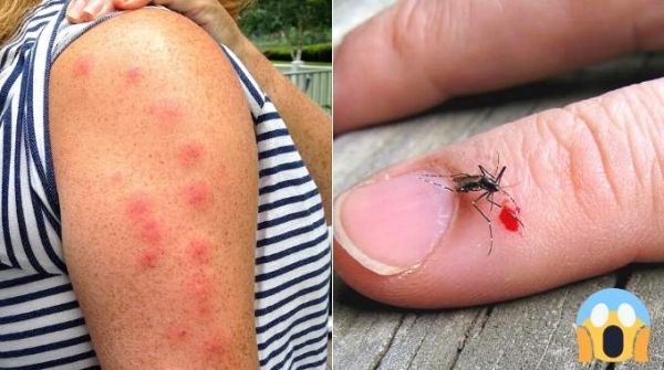 5 Remèdes de Grand-Mère Pour Apaiser N'importe Quelle Piqûre d'Insecte.