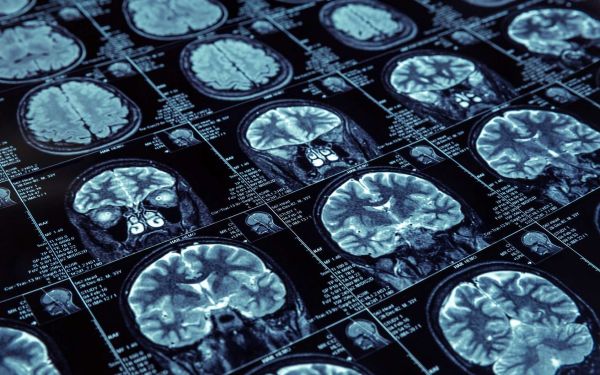 Une étude multigénérationnelle montre une association familiale entre hyperactivité et maladie d'Alzheimer