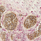 De nouvelles molécules pour traiter cancers du sein et métastases cérébrales