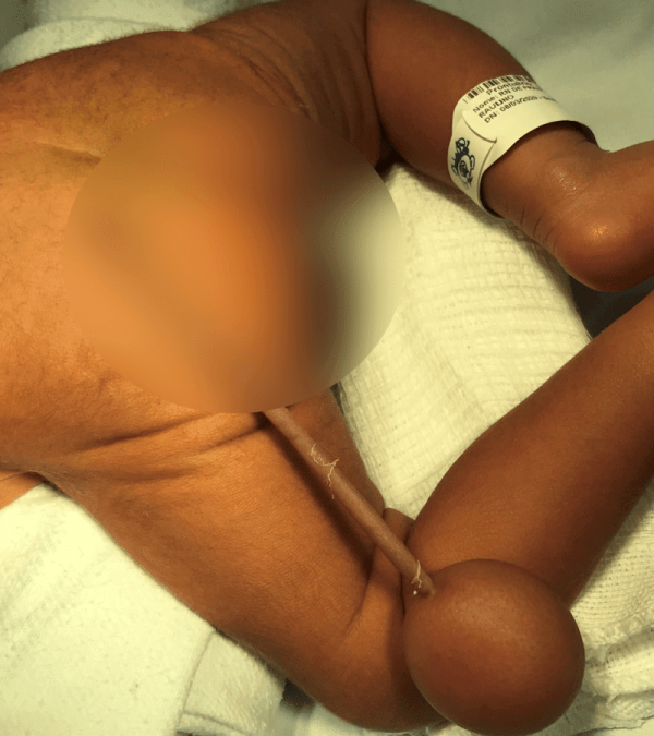 Au Brésil, un bébé naît avec une véritable queue