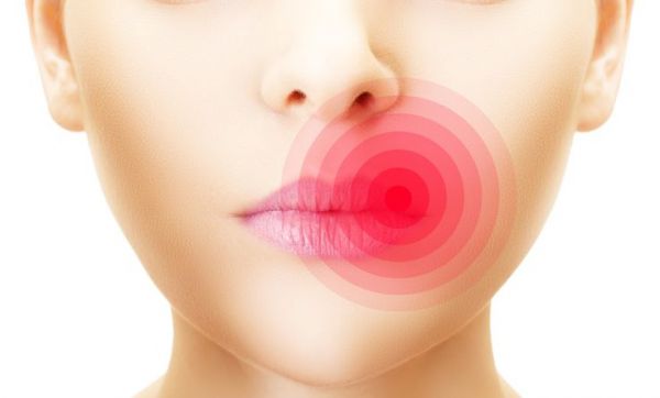 11 remèdes naturels pour traiter un bouton de fièvre