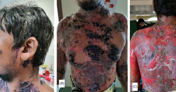 Développement d'un pemphigus vulgaire sévère après vaccination contre le CoV-19