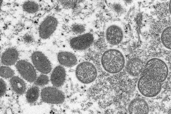 Variole du singe : un premier cas suspect détecté en France