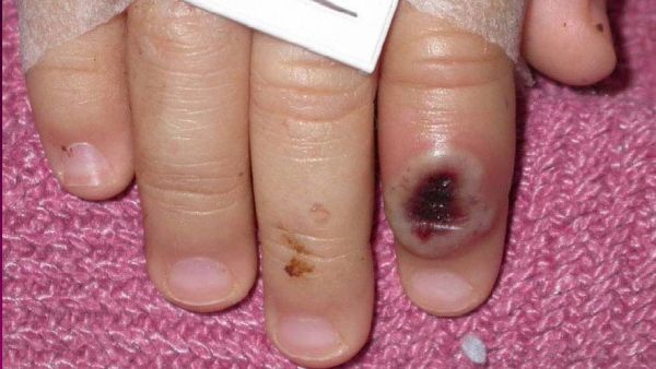 Variole du singe : pourquoi les pustules jouent un rôle décisif dans la propagation du Monkeypox ?
