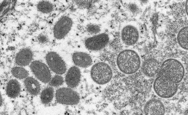 On fait le point sur l'épidémie du virus de la variole du singe en Europe