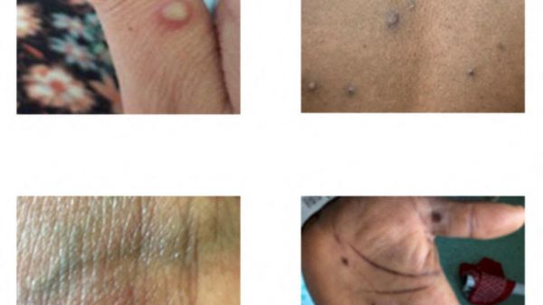 Variole du singe: des symptômes différents chez les patients européens