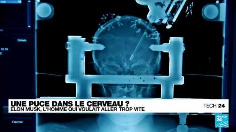 Projets d'implantation de puces dans le cerveau : ce qu'il faut savoir