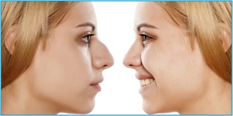 Comment se déroule une intervention de rhinoplastie en Tunisie ?