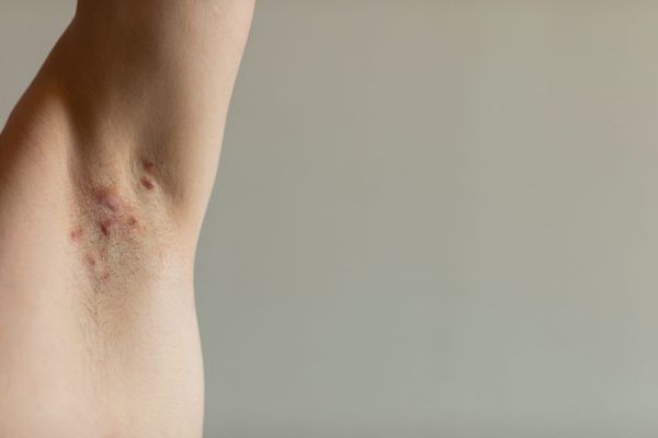 Maladie de Verneuil : photo, cause, traitement, c'est quoi ?