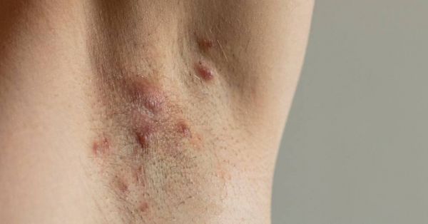 Maladie de Verneuil : une grande errance médicale