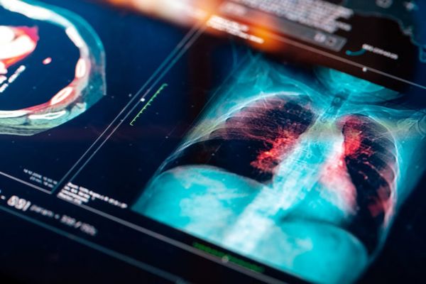 Un médicament contre le cancer parviendrait à vaincre l'inflammation liée au Covid-19