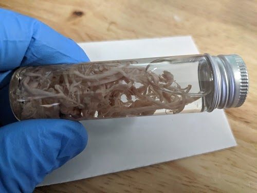 Développement d'un caillot caoutchouteux chez un individu non vacciné