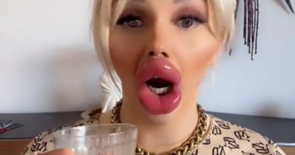 Cette femme aux lèvres énormes admet qu’il lui est difficile de boire et de manger