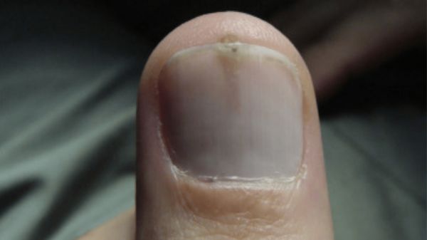 Cette anomalie sur l'ongle pourrait augmenter votre risque de cancer