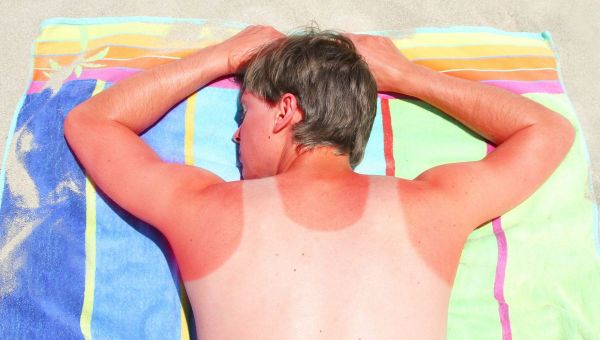 Comment soigner un coup de soleil ?