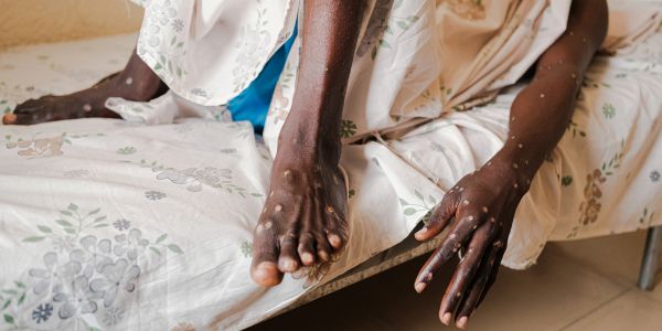 Mpox en Afrique : près d'un million de doses de vaccin attendues