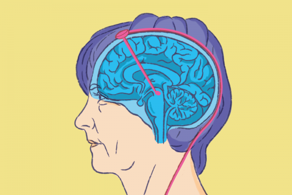Quand la lumière infrarouge stabilise la maladie de Parkinson
