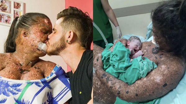Atteinte d'une maladie rare de la peau, les gens l'accusent d'être « irresponsable » pour avoir eu un enfant