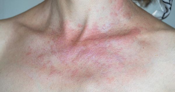 Santé. Photosensibilisation : quand soleil et médicaments ne font pas bon ménage