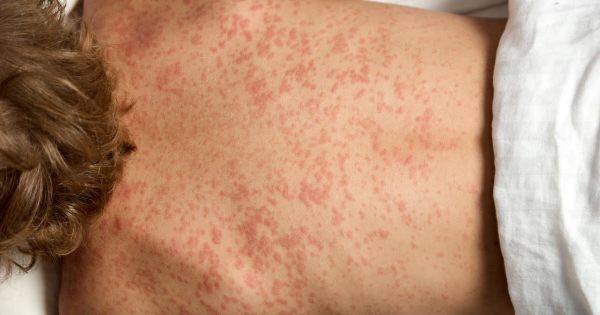 Santé. Hausse spectaculaire des cas de rougeole : êtes-vous correctement vacciné ?