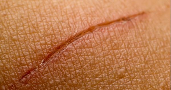 Les remèdes de grand-mère contre les cicatrices