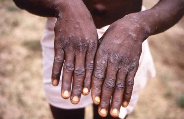Mpox (variole du singe) : 18 cas confirmés à Conakry et ses environs