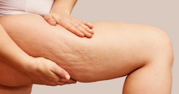 Santé. Comment se forme la cellulite et comment s'en débarrasser ?