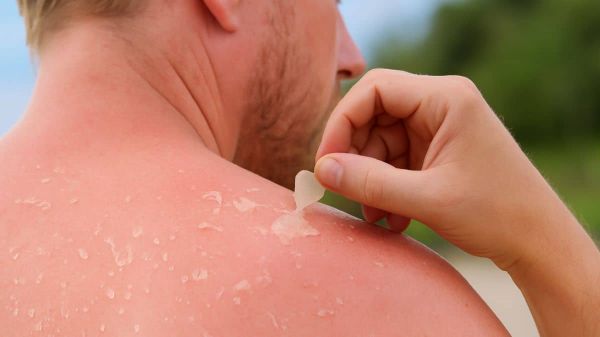 Peau qui pèle après un coup de soleil ? Voici les bons gestes à adopter